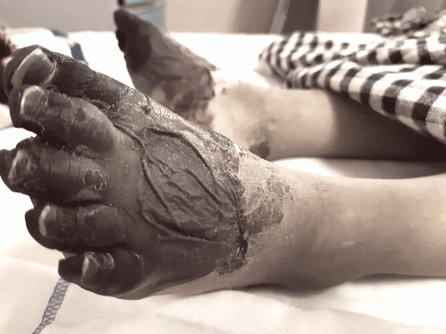 Chân của một em bé 3 tuổi bị nhiễm khuẩn huyết có nguy cơ bị cắt bỏ