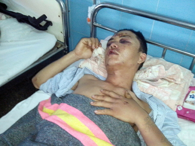 Đối tượng Lê Thế Hải đang được điều trị tại Bệnh viện hữu nghị Việt Nam - Cu Ba Đồng Hới