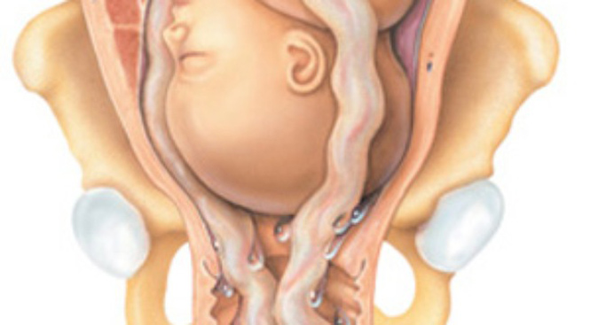  Dây rốn sa trong âm đạo.