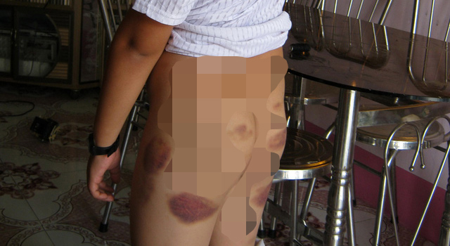  Những trường hợp trẻ bị bạo hành như thế này rất cần gọi đến đường dây nóng 111 để được hỗ trợ - Ảnh: Nguyễn Châu