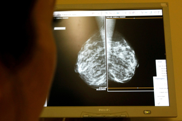 70% ca ung thư vú giai đoạn đầu không cần hóa trị sau phẫu thuật