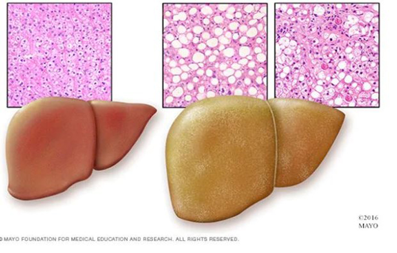 Khả năng phát hiện sớm bệnh gan nhiễm mỡ không do rượu