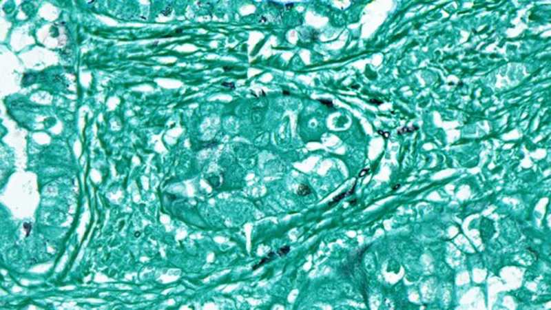 Phát hiện dấu vết của nhiều loại nấm trong các khối u ung thư