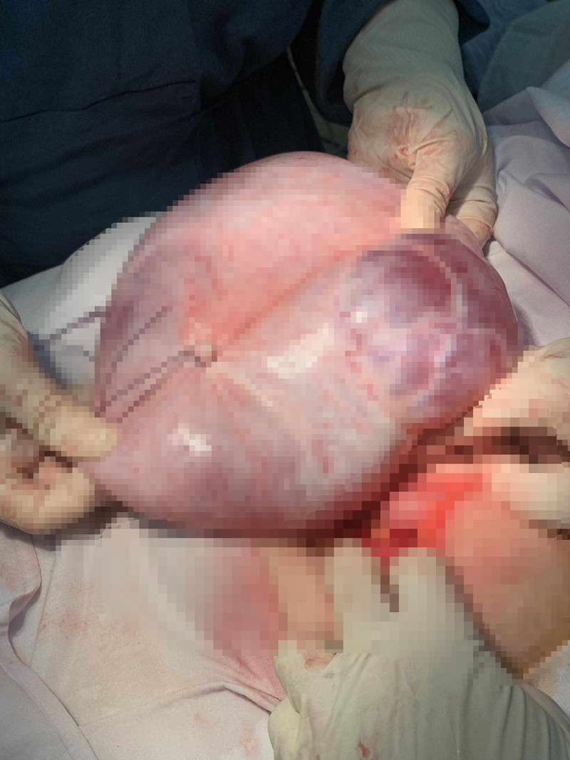 Phẫu thuật thành công bệnh nhân u nang buồng trứng nặng 5kg