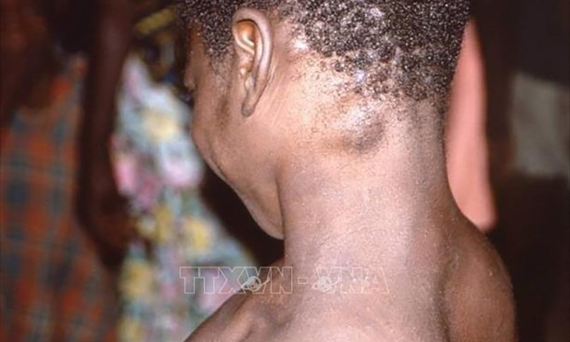 WHO triệu tập cuộc họp khẩn về sự lây lan của bệnh đậu mùa khỉ