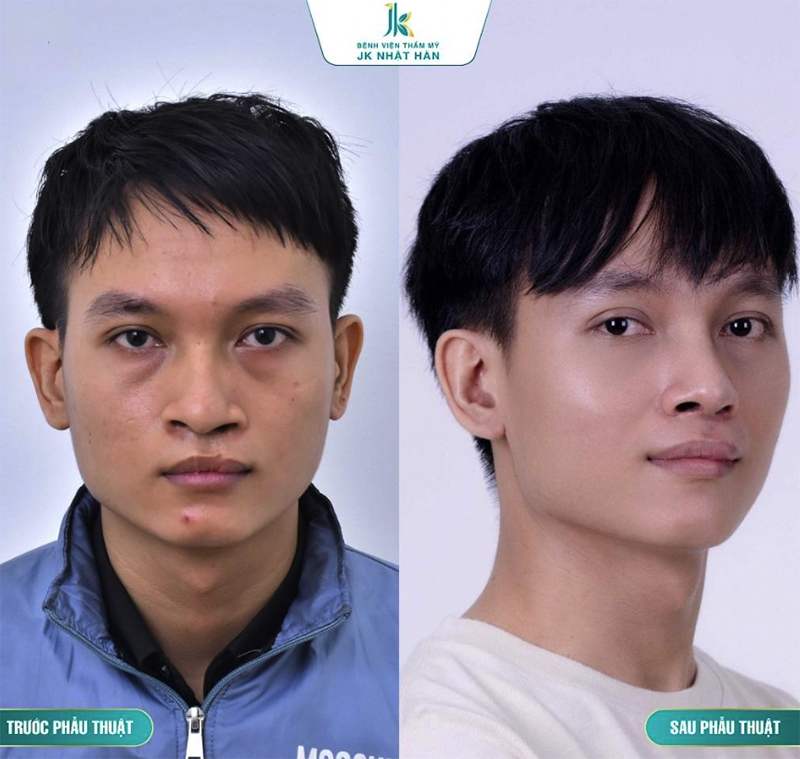 Ứng dụng vạt V-Y-Z trong tạo hình cánh mũi gãy cho các trường hợp mũi dị tật sứt môi hở hàm ếch