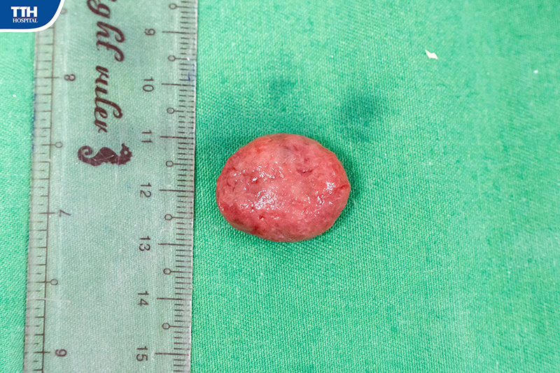 Bệnh nhi bị polyp đại tràng hiếm gặp được phát hiện và xử trí kịp thời tại TTH Quảng Bình